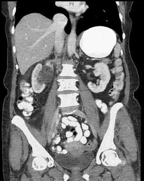 CT scan