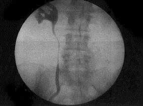 Pyelogram of the right ureter