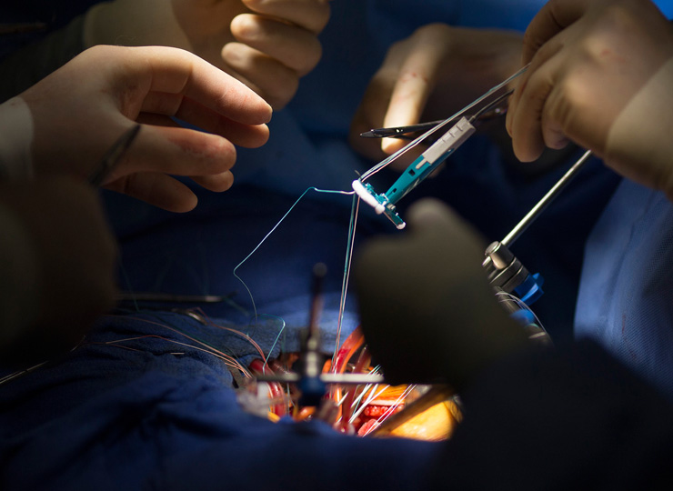 Image of cardiovascular surgical procedure in progress